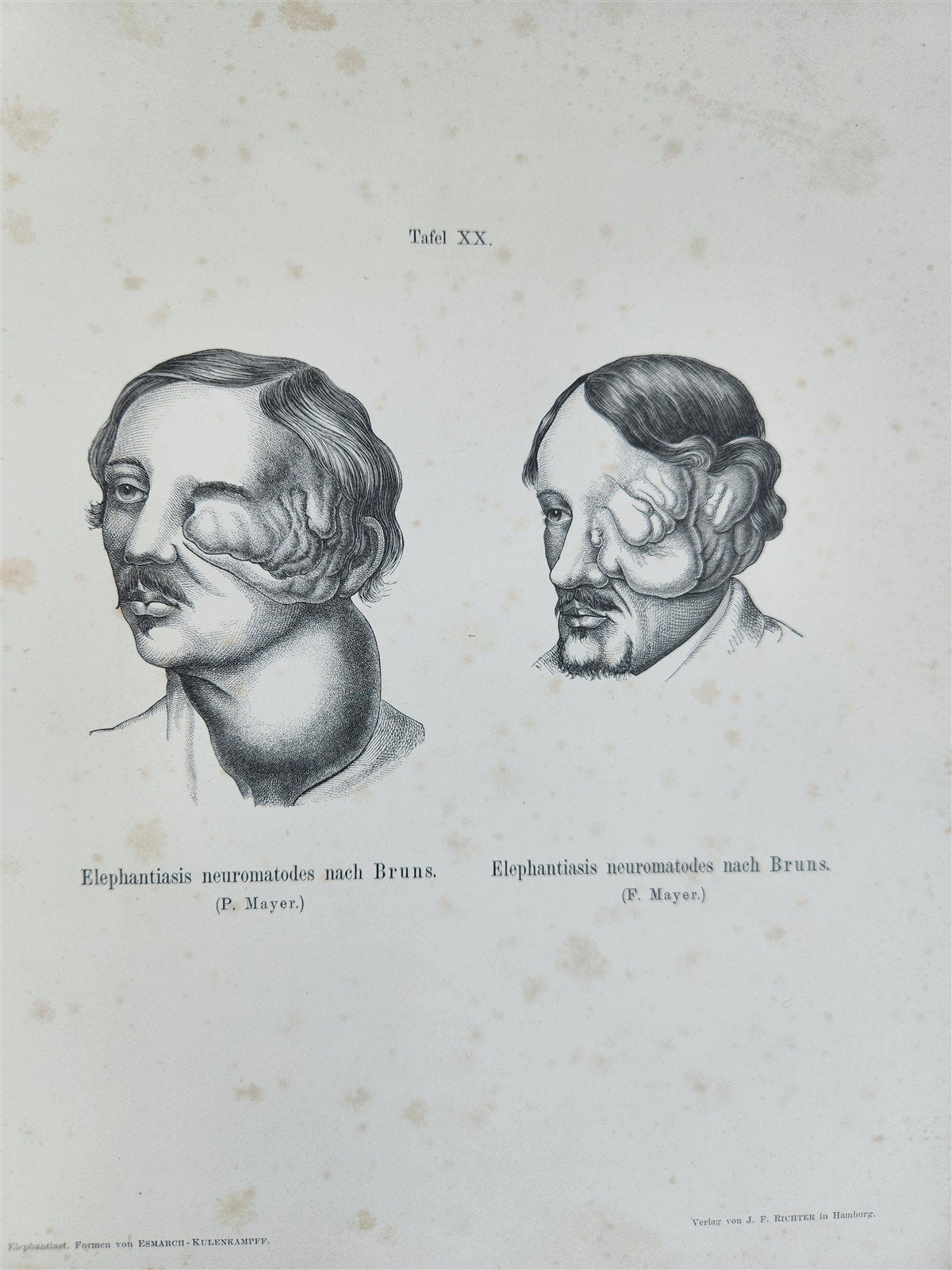 1885 ELEPHANTIASIS antique ILLUSTRATED FOLIO in GERMAN by Esmarch & Kulenkampff