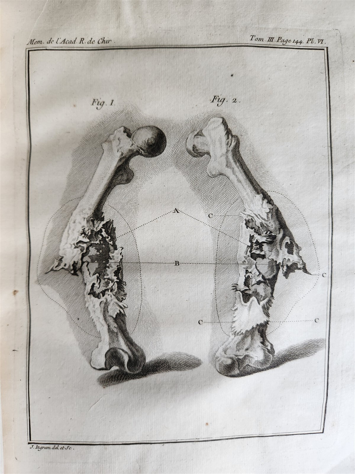 1753 SURGERY ANATOMY ILLUSTRATED antique Memoires l'Academie Royale de Chirurgie