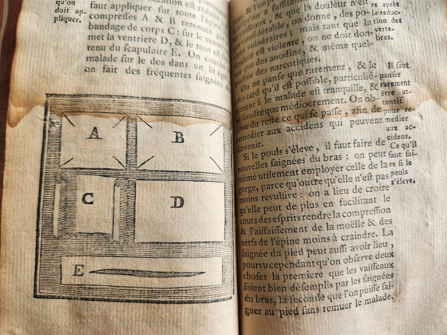 1775 Treatise on Diseases of Bones ILLUSTRATED MEDICAL DEVICES antique 2 VOLS