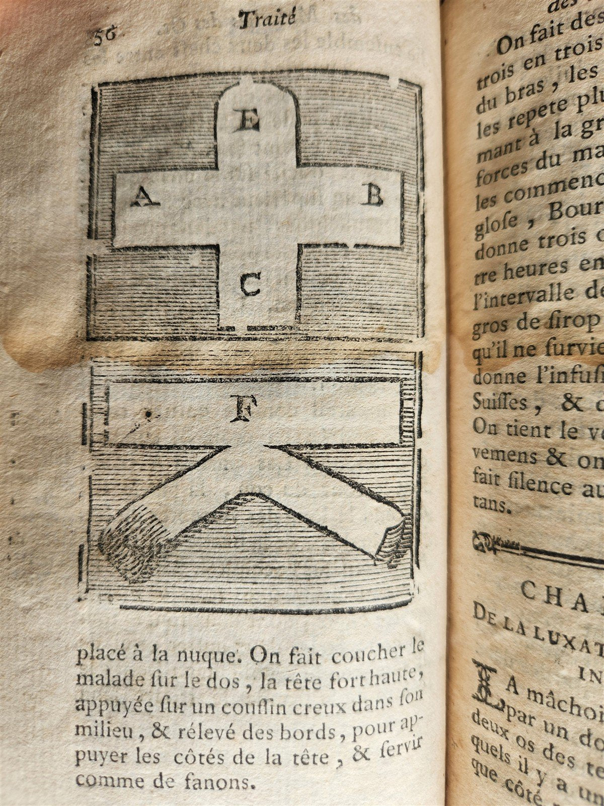 1775 Treatise on Diseases of Bones ILLUSTRATED MEDICAL DEVICES antique 2 VOLS