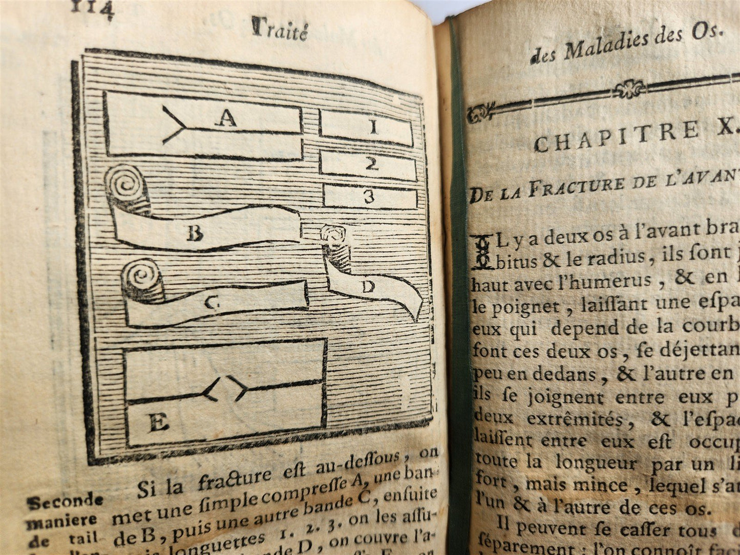 1775 Treatise on Diseases of Bones ILLUSTRATED MEDICAL DEVICES antique 2 VOLS