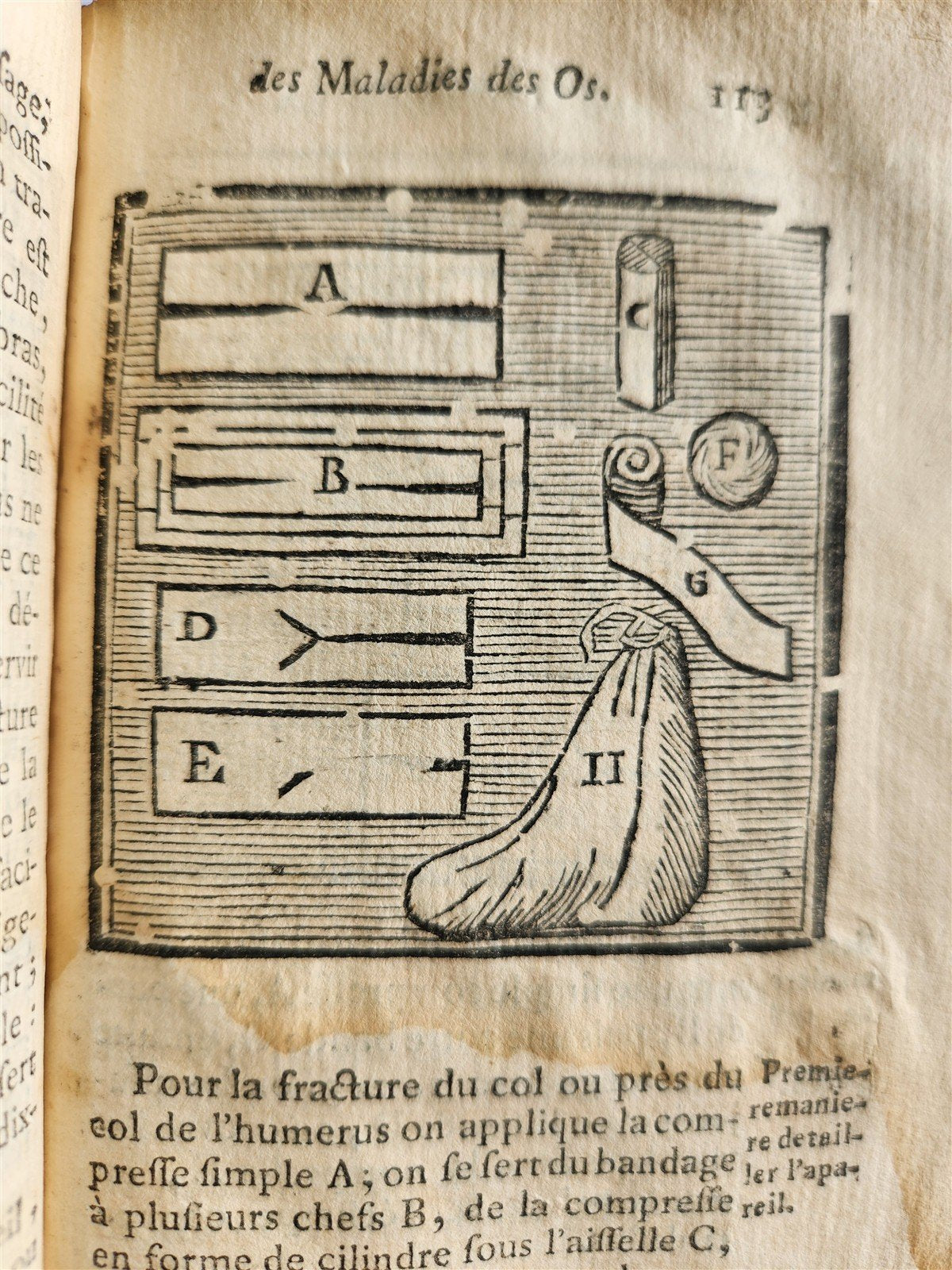 1775 Treatise on Diseases of Bones ILLUSTRATED MEDICAL DEVICES antique 2 VOLS