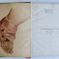 1885 ELEPHANTIASIS antique ILLUSTRATED FOLIO in GERMAN by Esmarch & Kulenkampff