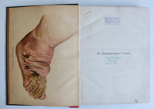 1885 ELEPHANTIASIS antique ILLUSTRATED FOLIO in GERMAN by Esmarch & Kulenkampff