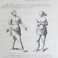 1885 ELEPHANTIASIS antique ILLUSTRATED FOLIO in GERMAN by Esmarch & Kulenkampff
