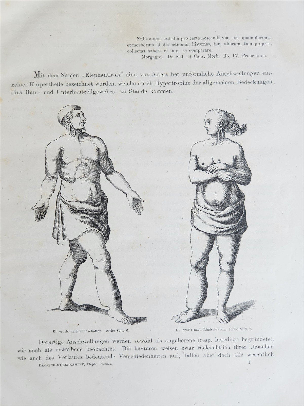 1885 ELEPHANTIASIS antique ILLUSTRATED FOLIO in GERMAN by Esmarch & Kulenkampff