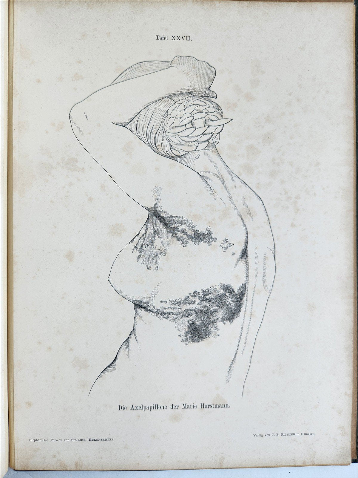 1885 ELEPHANTIASIS antique ILLUSTRATED FOLIO in GERMAN by Esmarch & Kulenkampff