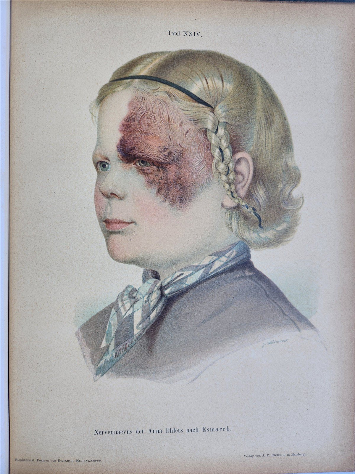 1885 ELEPHANTIASIS antique ILLUSTRATED FOLIO in GERMAN by Esmarch & Kulenkampff