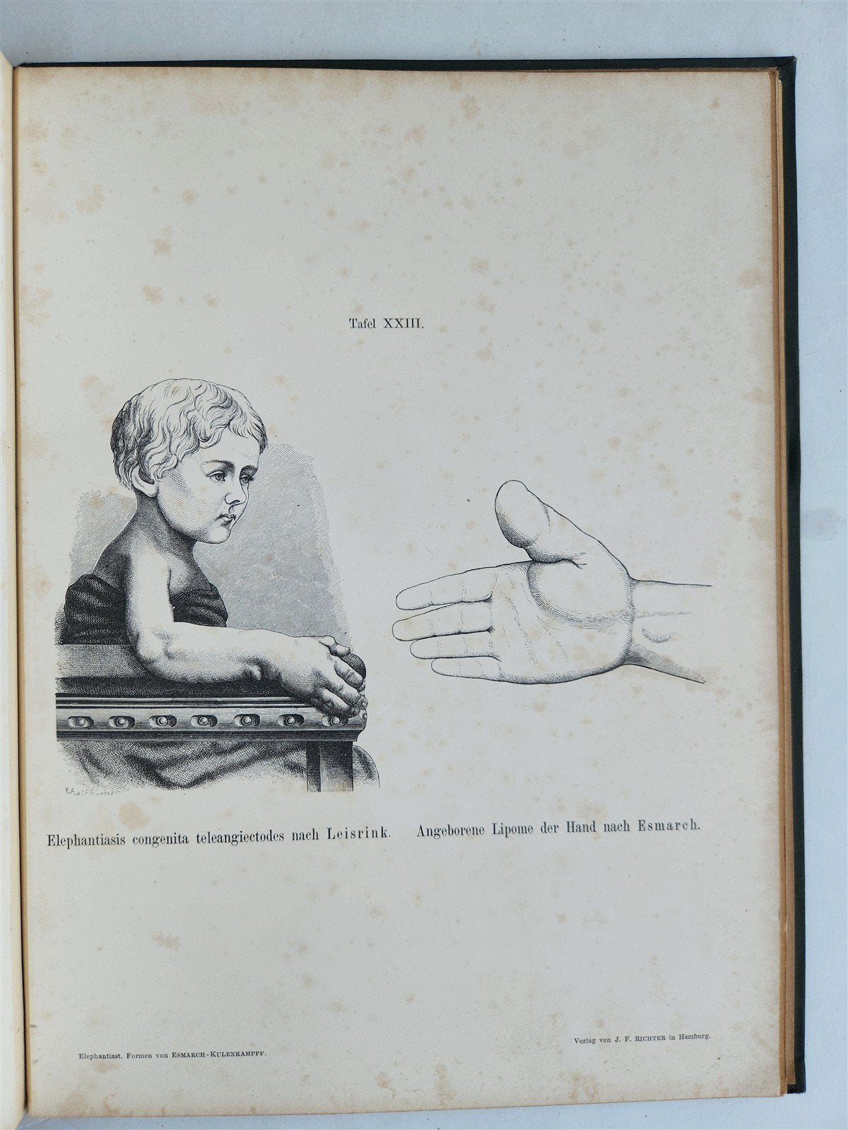 1885 ELEPHANTIASIS antique ILLUSTRATED FOLIO in GERMAN by Esmarch & Kulenkampff