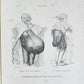 1885 ELEPHANTIASIS antique ILLUSTRATED FOLIO in GERMAN by Esmarch & Kulenkampff