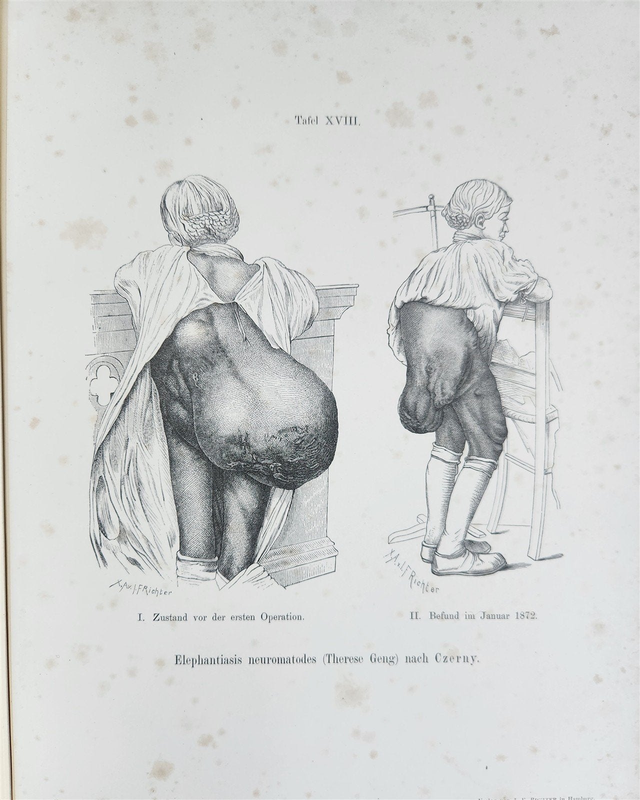 1885 ELEPHANTIASIS antique ILLUSTRATED FOLIO in GERMAN by Esmarch & Kulenkampff