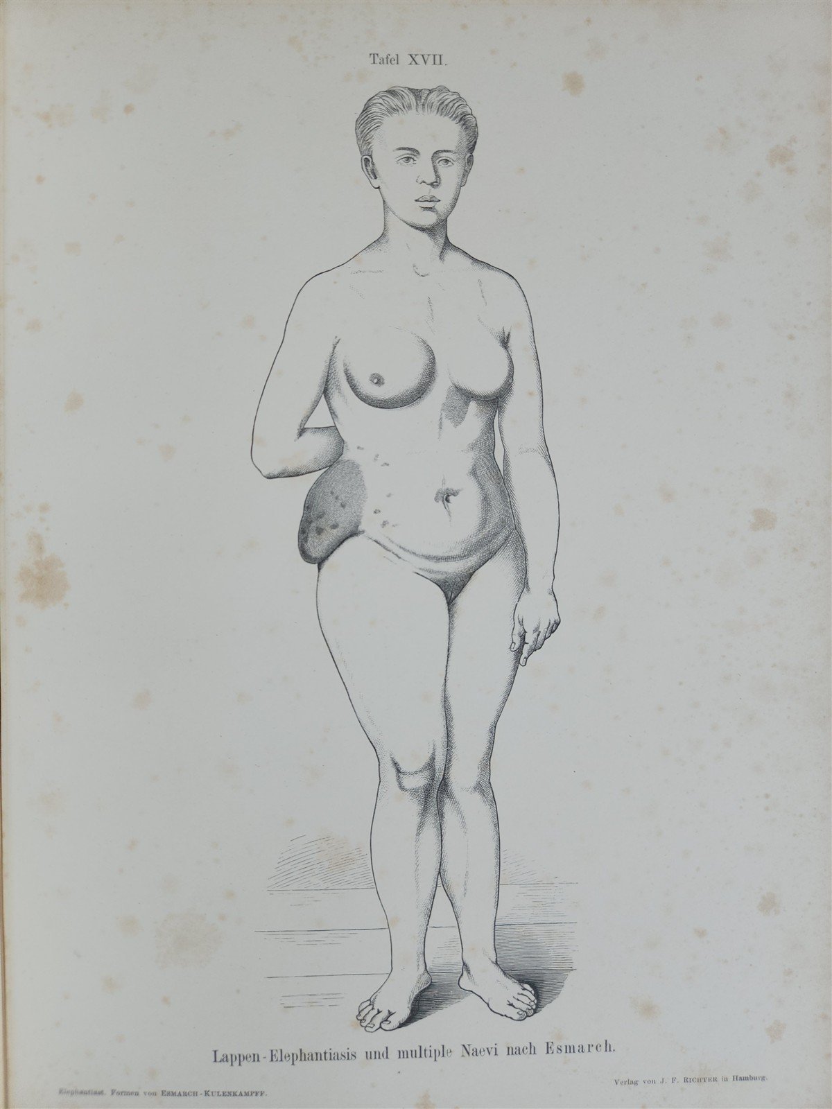1885 ELEPHANTIASIS antique ILLUSTRATED FOLIO in GERMAN by Esmarch & Kulenkampff