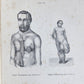 1885 ELEPHANTIASIS antique ILLUSTRATED FOLIO in GERMAN by Esmarch & Kulenkampff