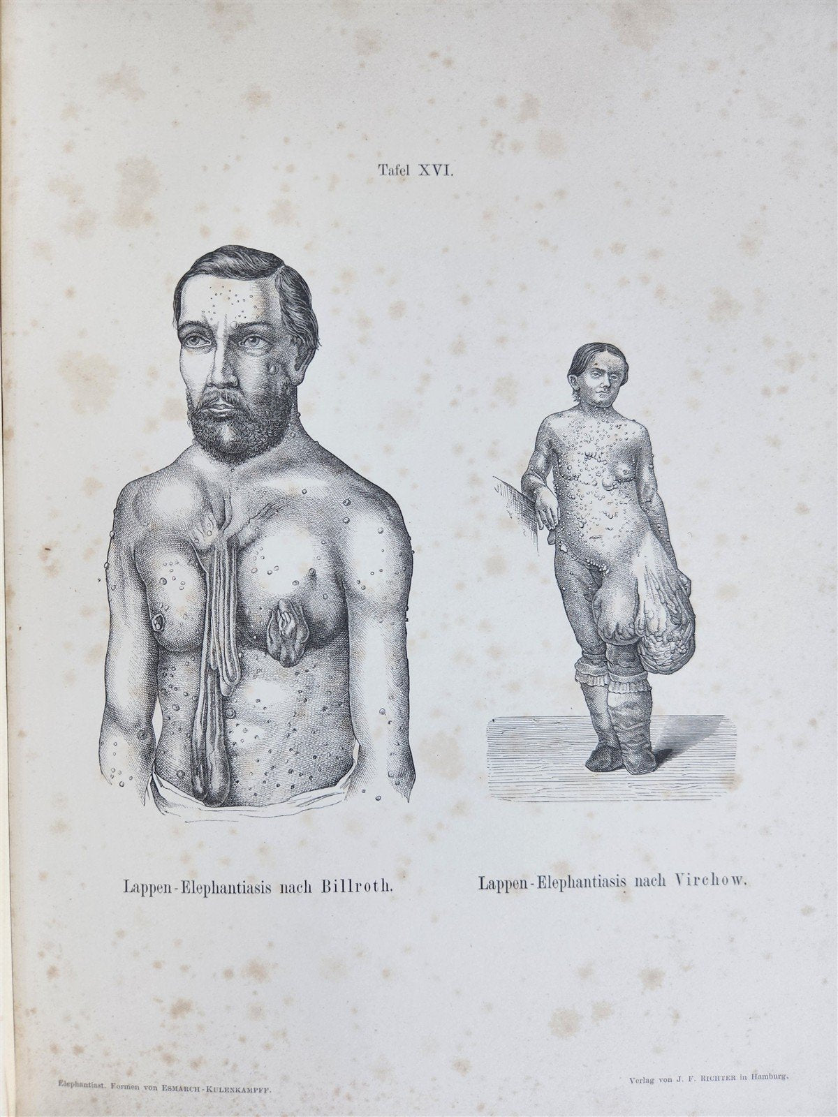 1885 ELEPHANTIASIS antique ILLUSTRATED FOLIO in GERMAN by Esmarch & Kulenkampff
