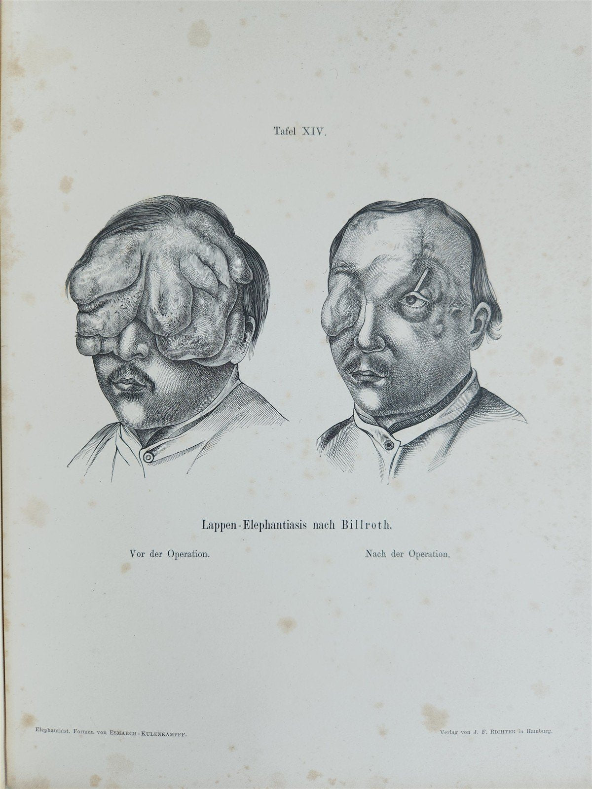 1885 ELEPHANTIASIS antique ILLUSTRATED FOLIO in GERMAN by Esmarch & Kulenkampff