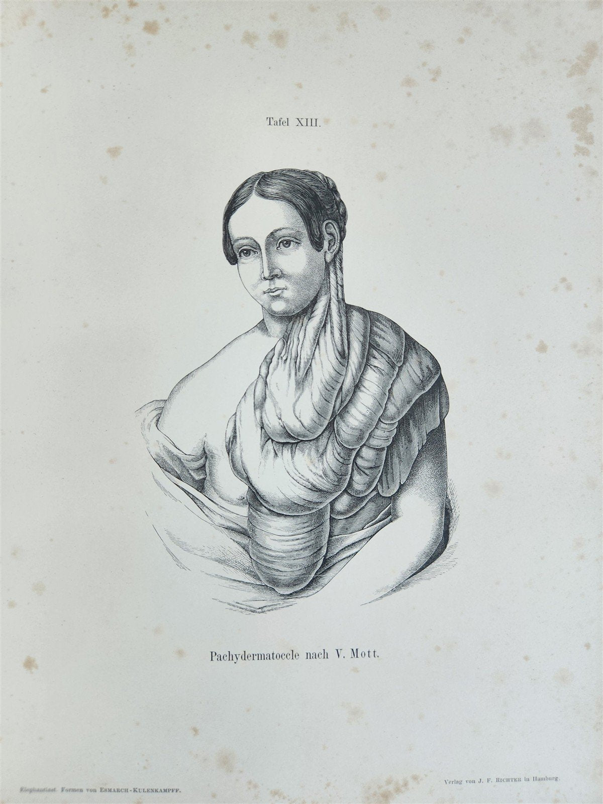 1885 ELEPHANTIASIS antique ILLUSTRATED FOLIO in GERMAN by Esmarch & Kulenkampff