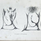 1885 ELEPHANTIASIS antique ILLUSTRATED FOLIO in GERMAN by Esmarch & Kulenkampff