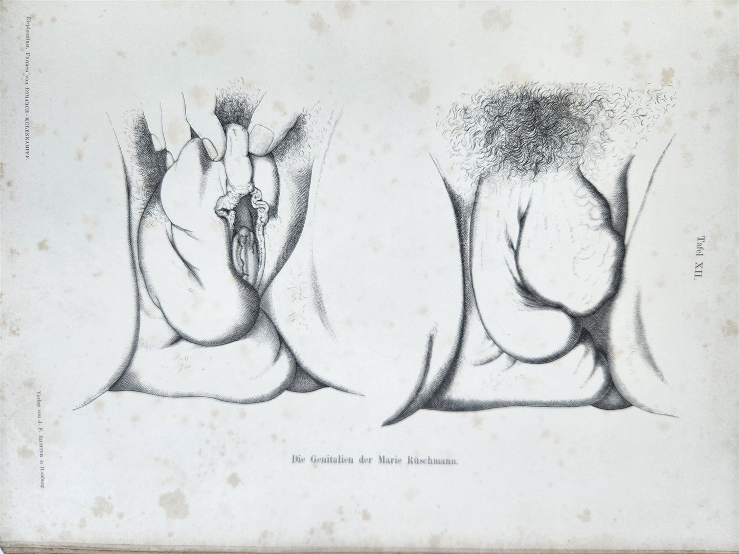 1885 ELEPHANTIASIS antique ILLUSTRATED FOLIO in GERMAN by Esmarch & Kulenkampff
