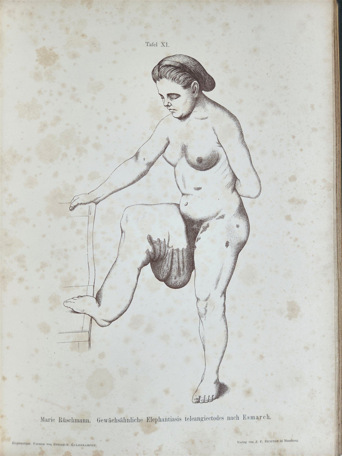 1885 ELEPHANTIASIS antique ILLUSTRATED FOLIO in GERMAN by Esmarch & Kulenkampff