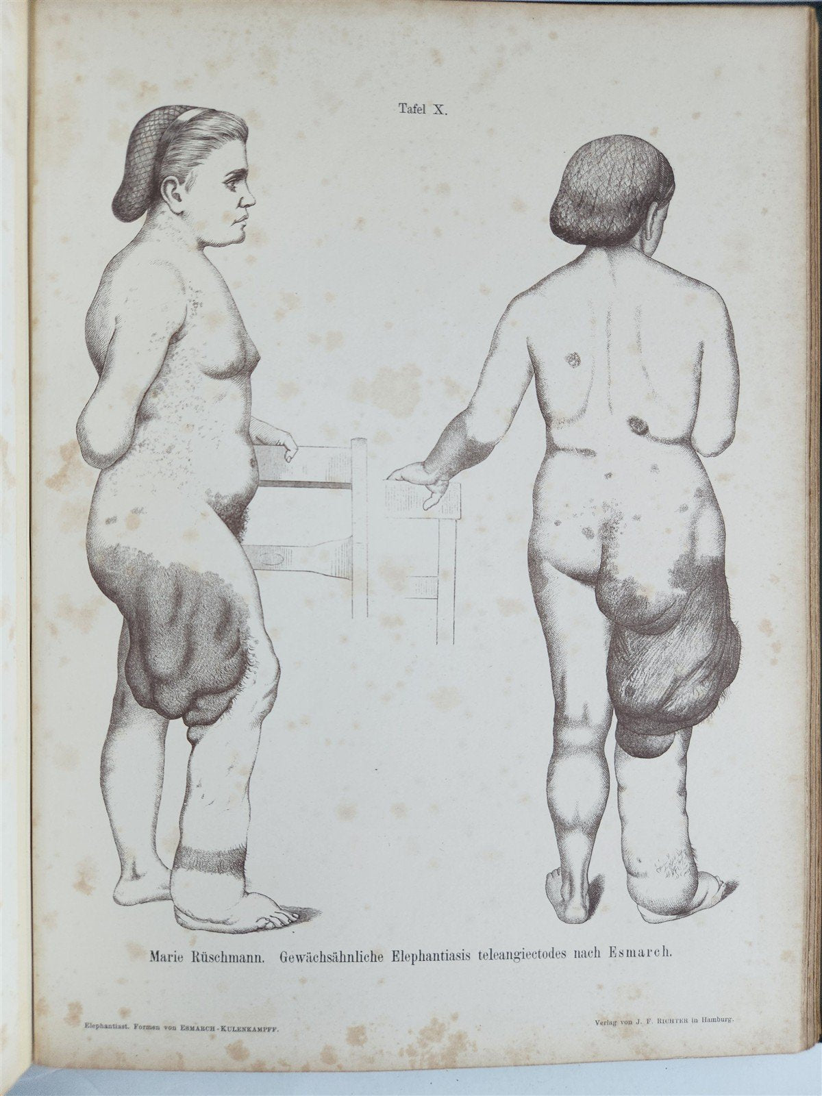 1885 ELEPHANTIASIS antique ILLUSTRATED FOLIO in GERMAN by Esmarch & Kulenkampff