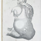 1885 ELEPHANTIASIS antique ILLUSTRATED FOLIO in GERMAN by Esmarch & Kulenkampff