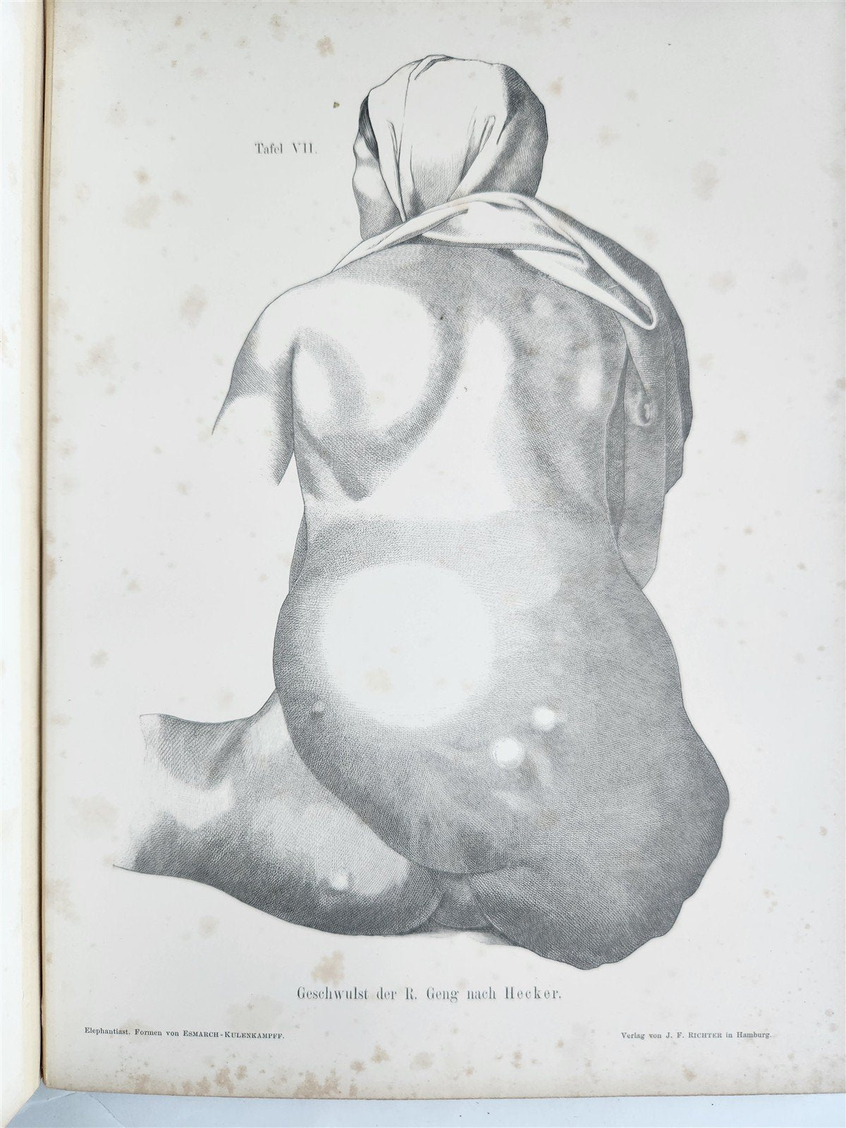 1885 ELEPHANTIASIS antique ILLUSTRATED FOLIO in GERMAN by Esmarch & Kulenkampff