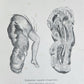 1885 ELEPHANTIASIS antique ILLUSTRATED FOLIO in GERMAN by Esmarch & Kulenkampff