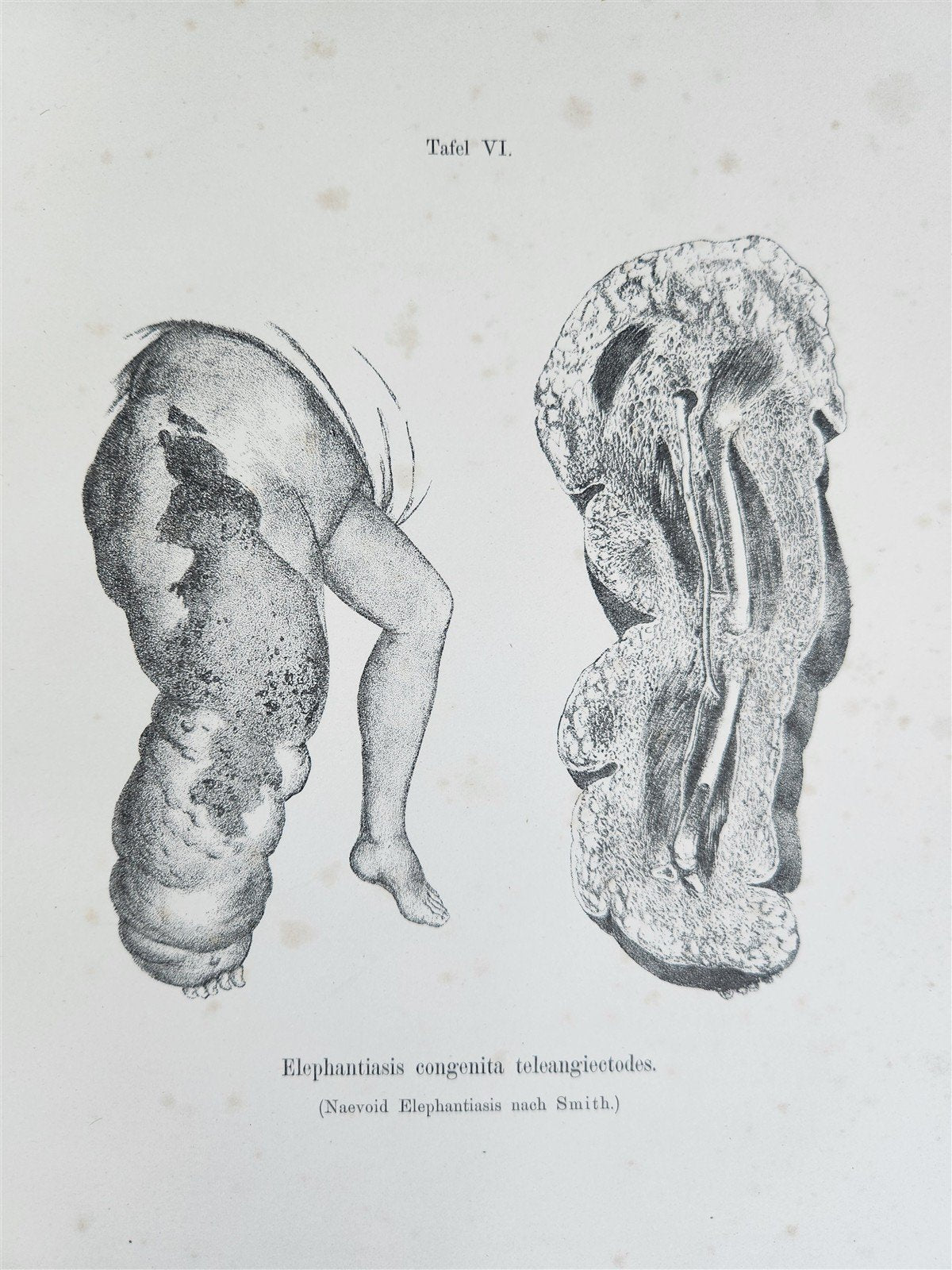 1885 ELEPHANTIASIS antique ILLUSTRATED FOLIO in GERMAN by Esmarch & Kulenkampff