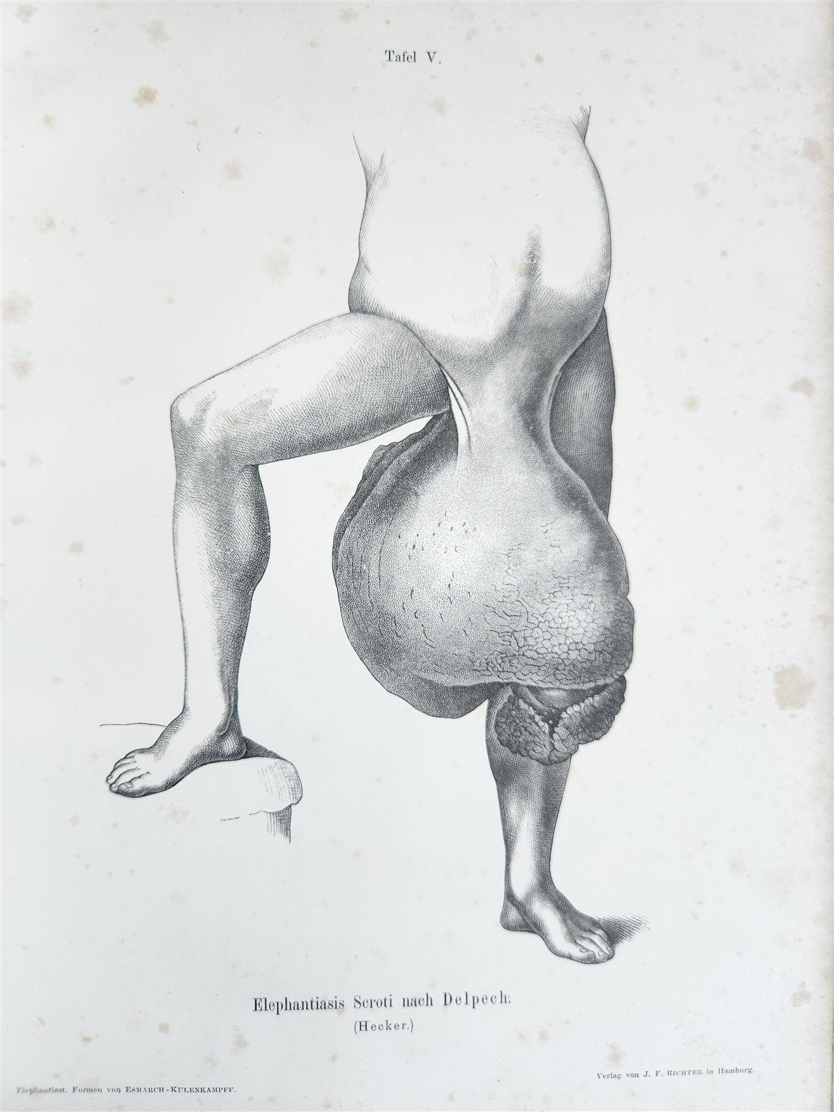 1885 ELEPHANTIASIS antique ILLUSTRATED FOLIO in GERMAN by Esmarch & Kulenkampff