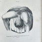 1885 ELEPHANTIASIS antique ILLUSTRATED FOLIO in GERMAN by Esmarch & Kulenkampff