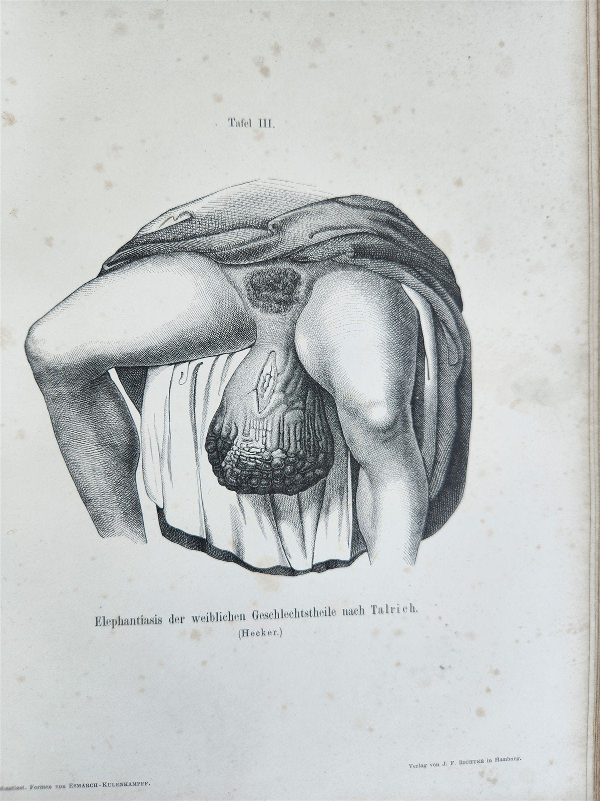 1885 ELEPHANTIASIS antique ILLUSTRATED FOLIO in GERMAN by Esmarch & Kulenkampff