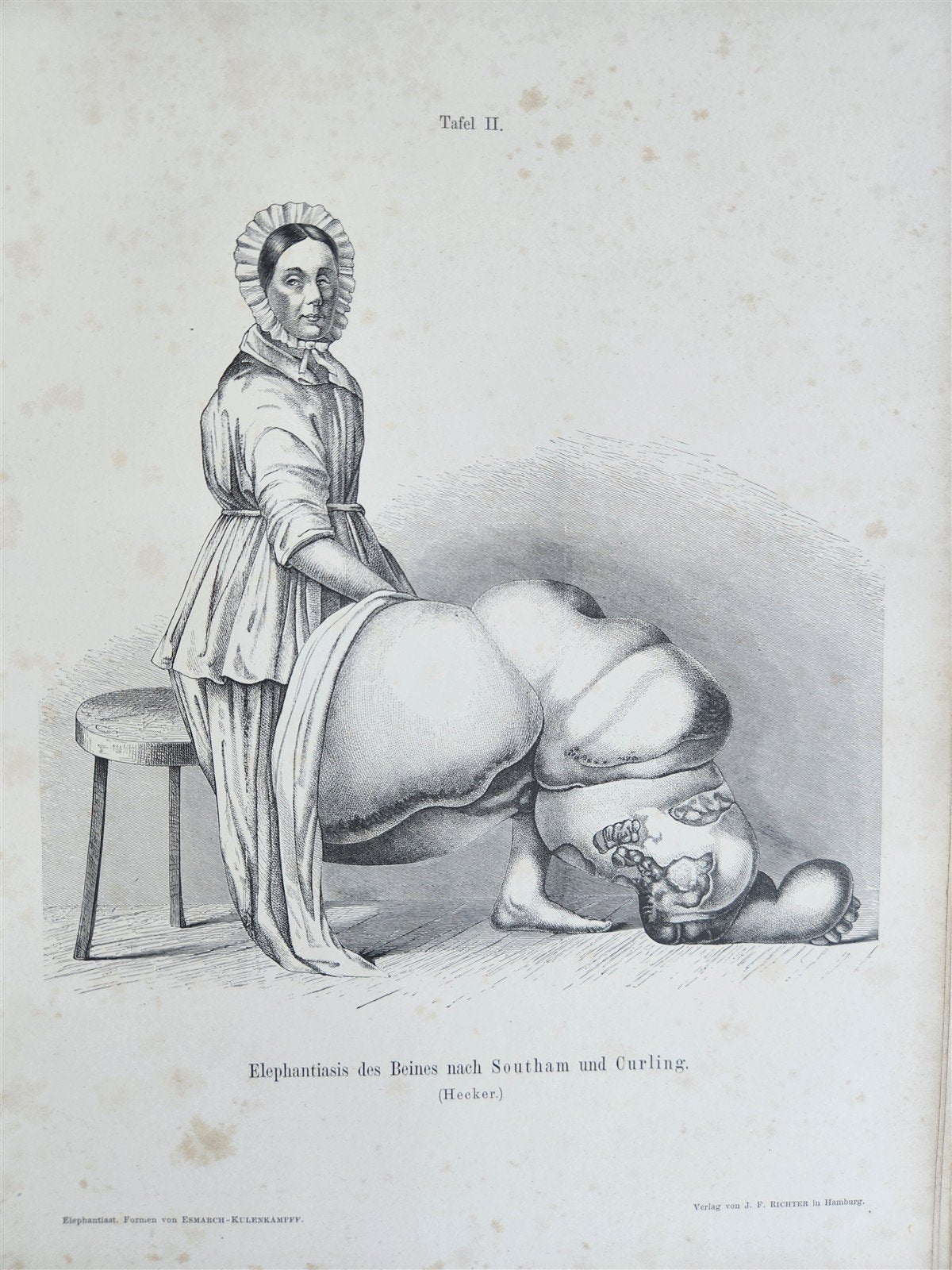 1885 ELEPHANTIASIS antique ILLUSTRATED FOLIO in GERMAN by Esmarch & Kulenkampff