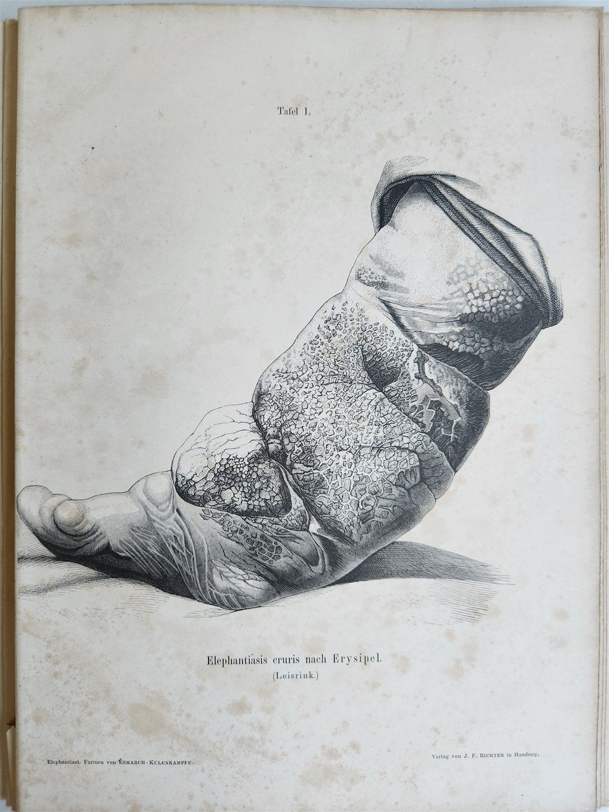 1885 ELEPHANTIASIS antique ILLUSTRATED FOLIO in GERMAN by Esmarch & Kulenkampff