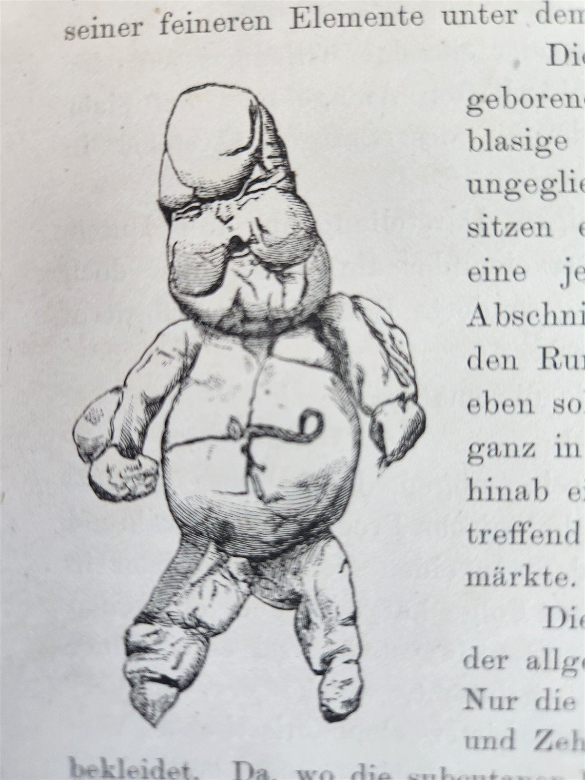 1885 ELEPHANTIASIS antique ILLUSTRATED FOLIO in GERMAN by Esmarch & Kulenkampff