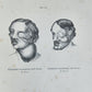 1885 ELEPHANTIASIS antique ILLUSTRATED FOLIO in GERMAN by Esmarch & Kulenkampff
