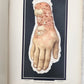 1895 PICTORIAL ATLAS of SKIN DISEASES & SYPHILITIC AFFECTION antique ILLUSTRATED