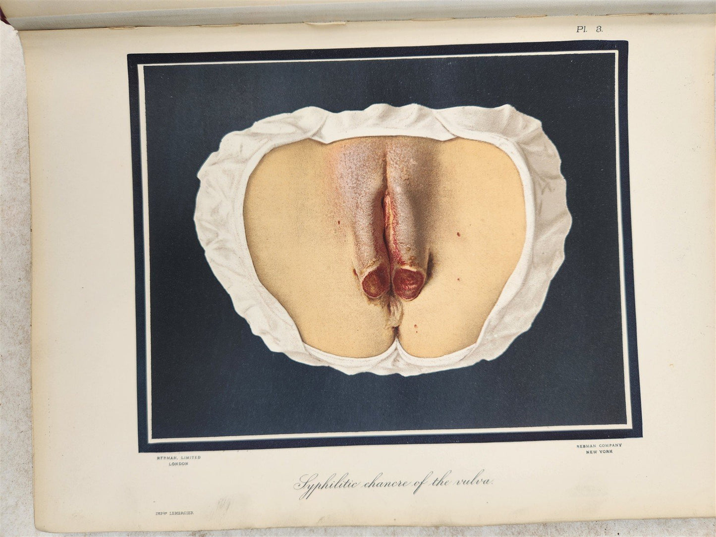 1895 PICTORIAL ATLAS of SKIN DISEASES & SYPHILITIC AFFECTION antique ILLUSTRATED