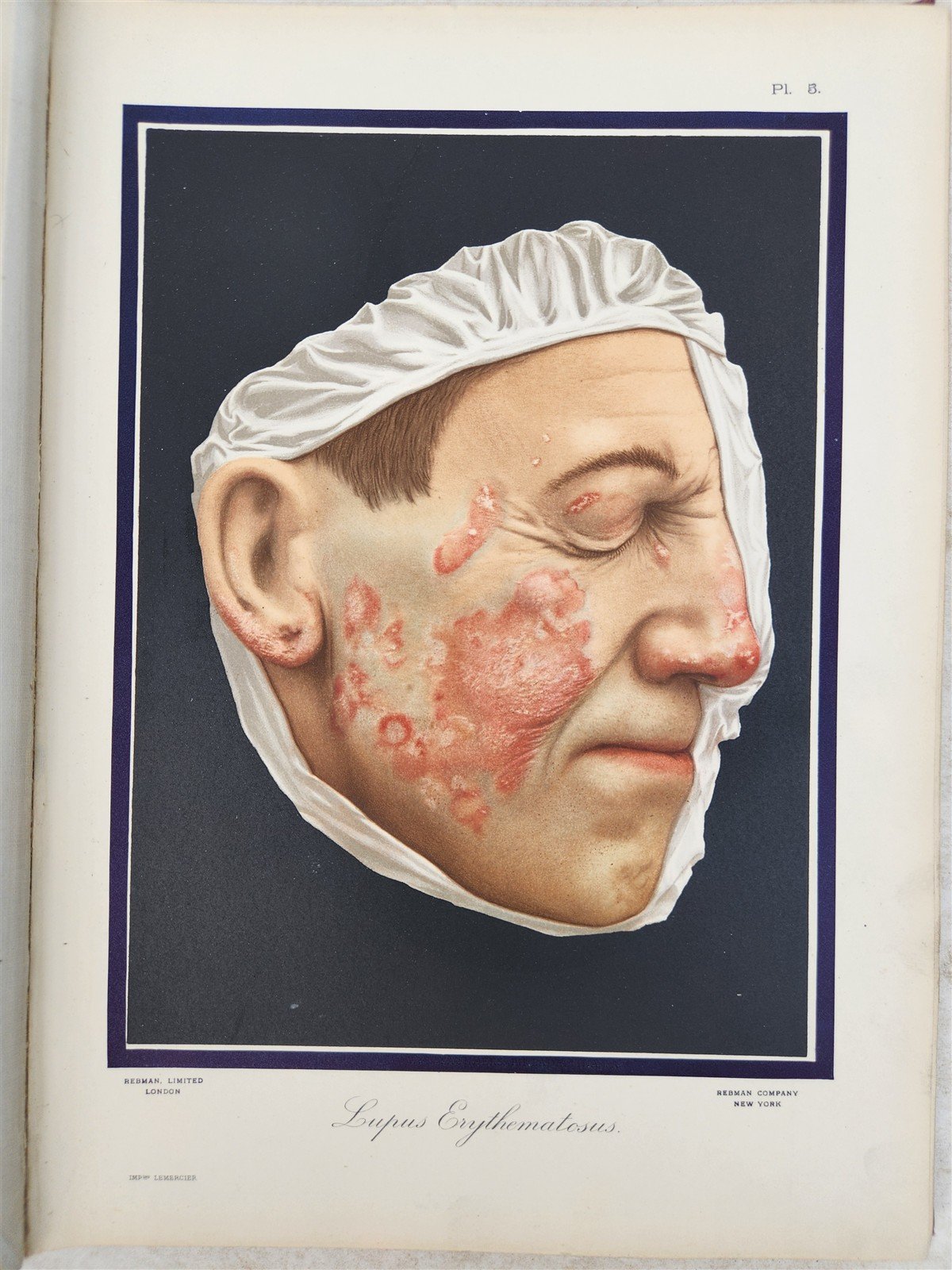 1895 PICTORIAL ATLAS of SKIN DISEASES & SYPHILITIC AFFECTION antique ILLUSTRATED