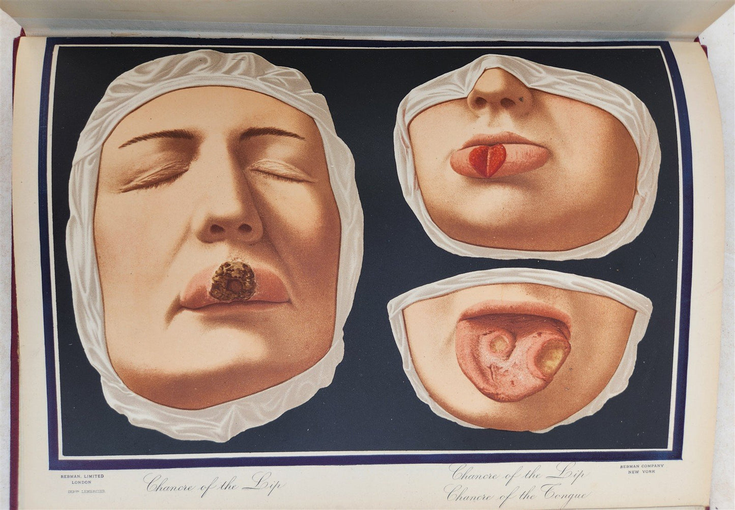 1895 PICTORIAL ATLAS of SKIN DISEASES & SYPHILITIC AFFECTION antique ILLUSTRATED