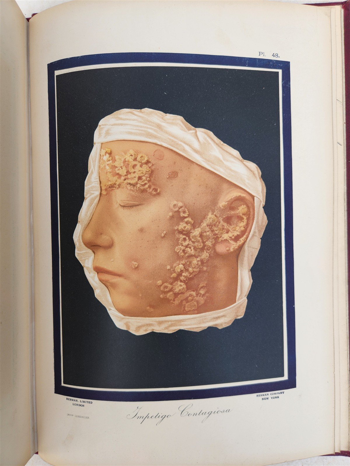 1895 PICTORIAL ATLAS of SKIN DISEASES & SYPHILITIC AFFECTION antique ILLUSTRATED