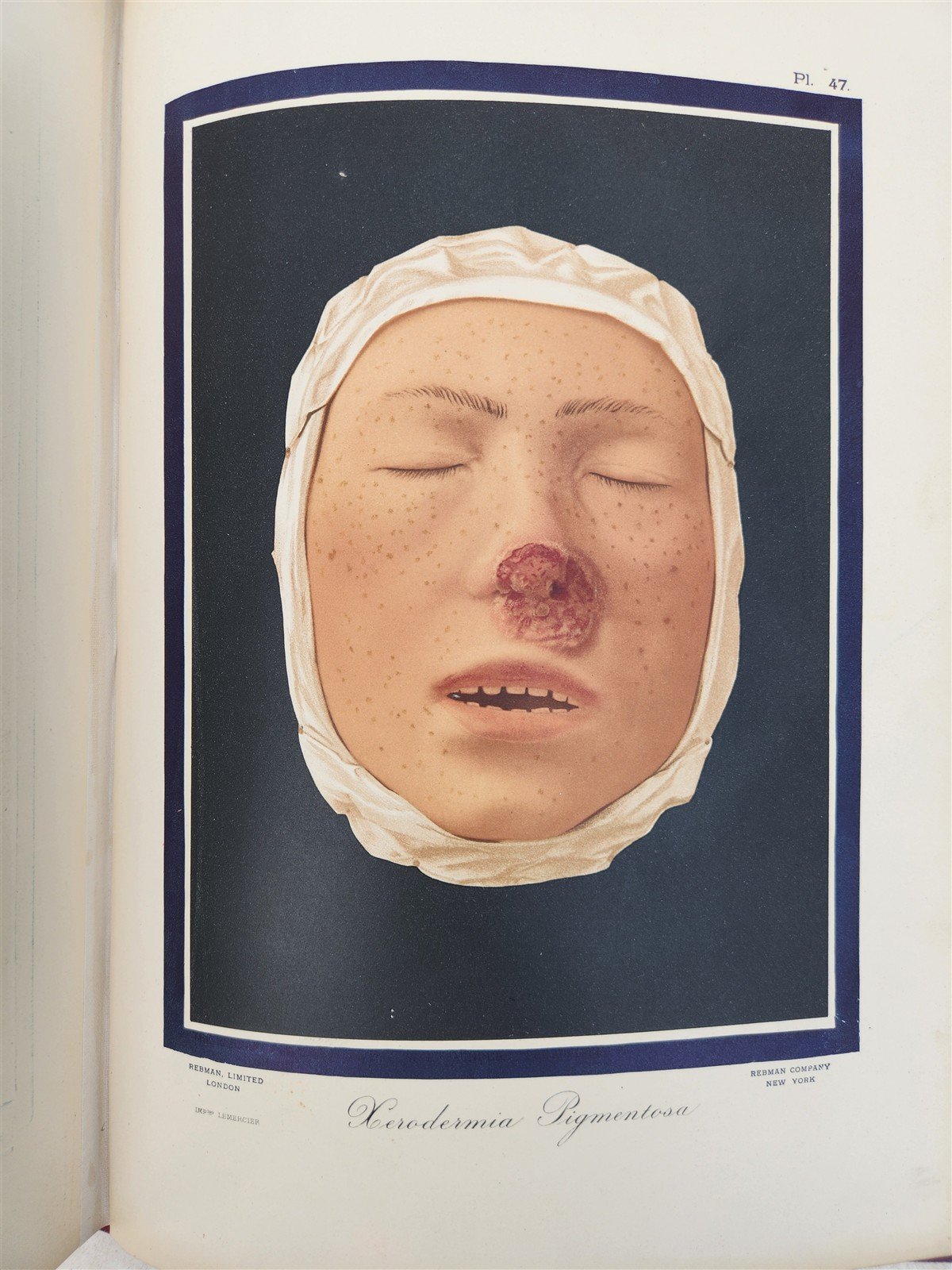 1895 PICTORIAL ATLAS of SKIN DISEASES & SYPHILITIC AFFECTION antique ILLUSTRATED