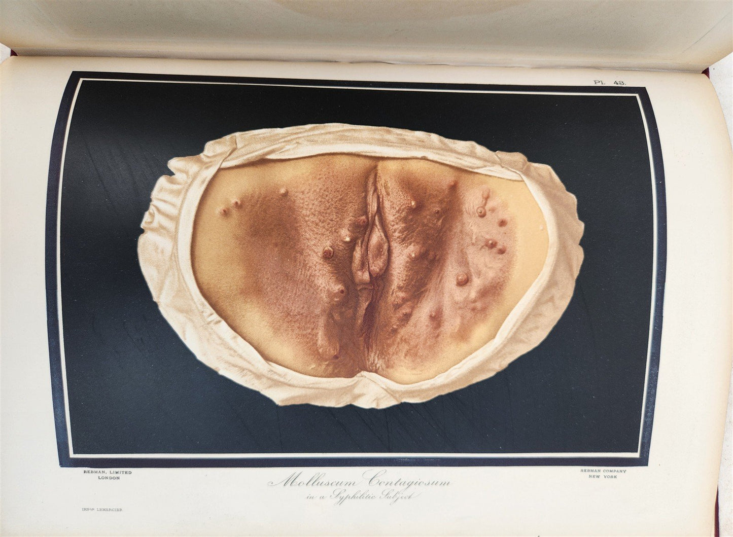 1895 PICTORIAL ATLAS of SKIN DISEASES & SYPHILITIC AFFECTION antique ILLUSTRATED