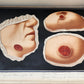 1895 PICTORIAL ATLAS of SKIN DISEASES & SYPHILITIC AFFECTION antique ILLUSTRATED