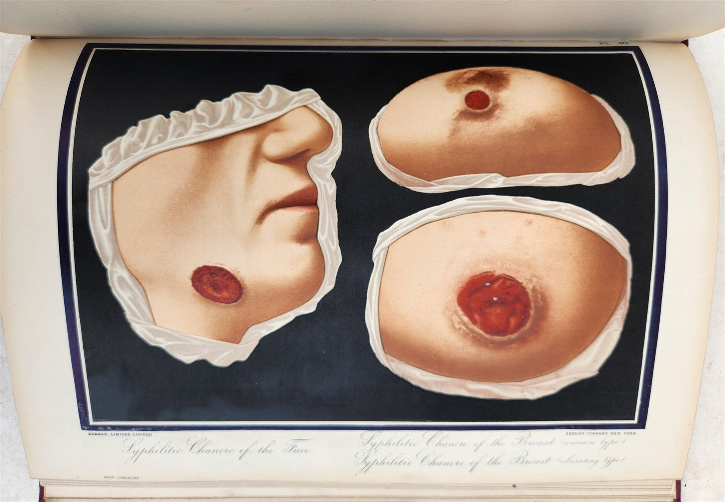 1895 PICTORIAL ATLAS of SKIN DISEASES & SYPHILITIC AFFECTION antique ILLUSTRATED