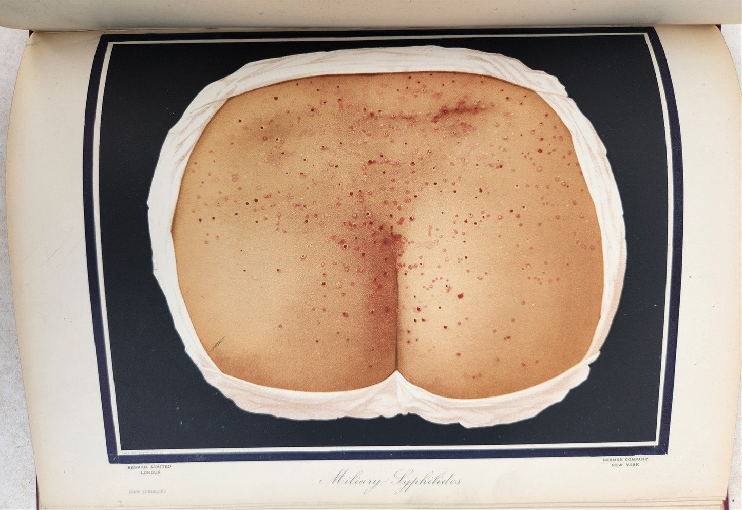 1895 PICTORIAL ATLAS of SKIN DISEASES & SYPHILITIC AFFECTION antique ILLUSTRATED