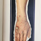 1895 PICTORIAL ATLAS of SKIN DISEASES & SYPHILITIC AFFECTION antique ILLUSTRATED