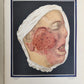 1895 PICTORIAL ATLAS of SKIN DISEASES & SYPHILITIC AFFECTION antique ILLUSTRATED