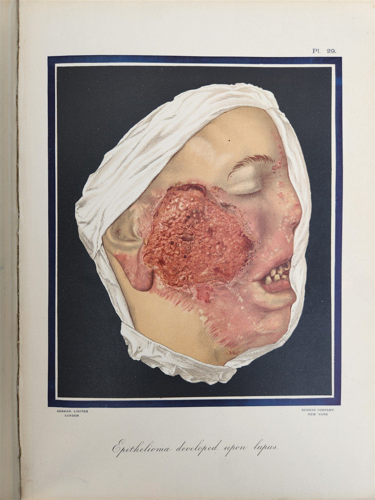 1895 PICTORIAL ATLAS of SKIN DISEASES & SYPHILITIC AFFECTION antique ILLUSTRATED