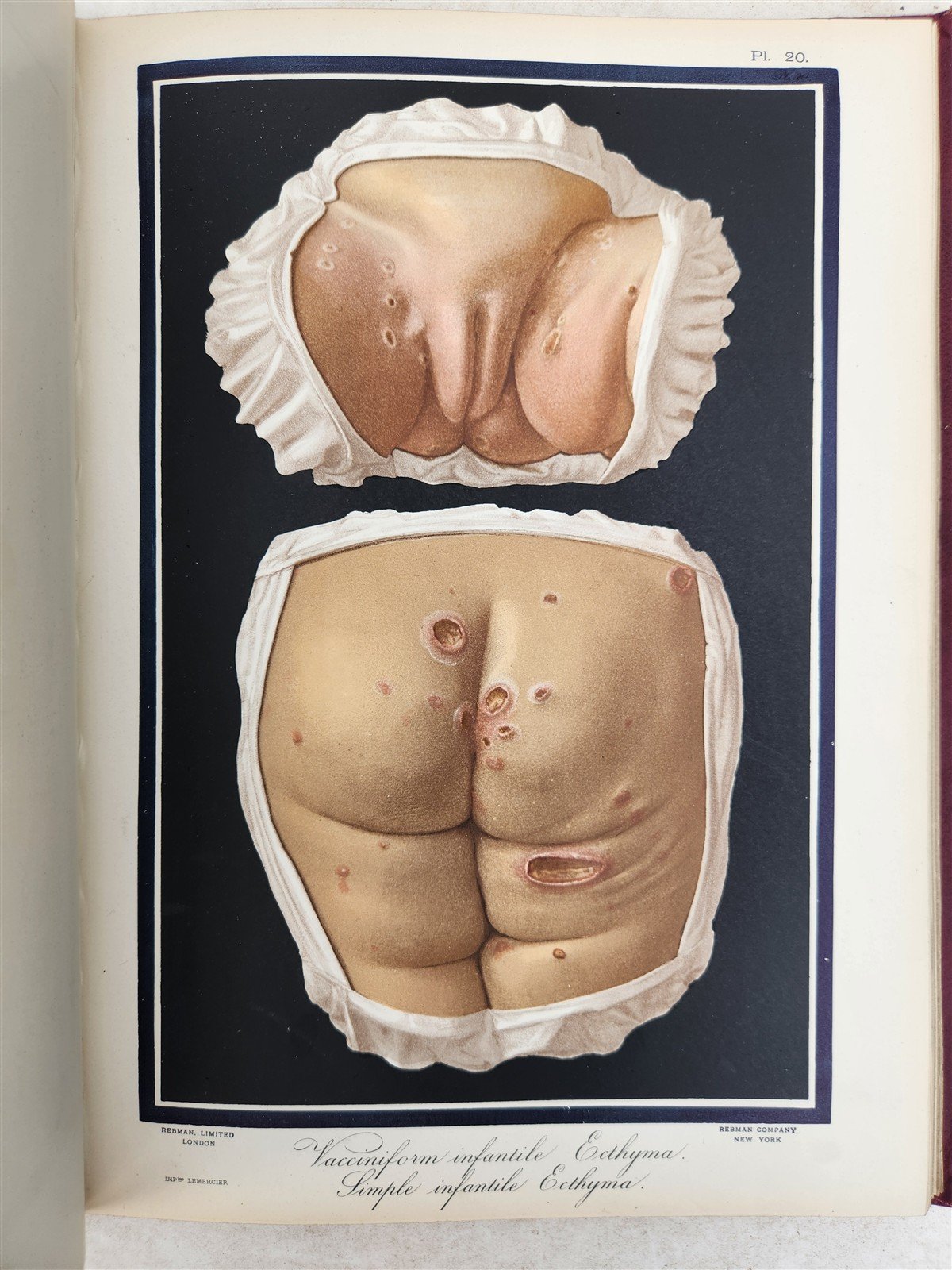 1895 PICTORIAL ATLAS of SKIN DISEASES & SYPHILITIC AFFECTION antique ILLUSTRATED