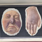 1895 PICTORIAL ATLAS of SKIN DISEASES & SYPHILITIC AFFECTION antique ILLUSTRATED